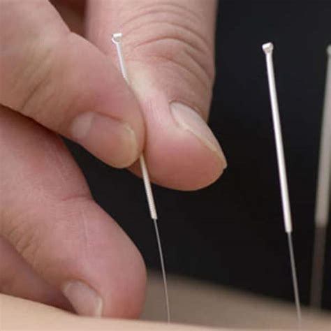 acupuncture kalgoorlie|Acupuncture & Dry Needling .